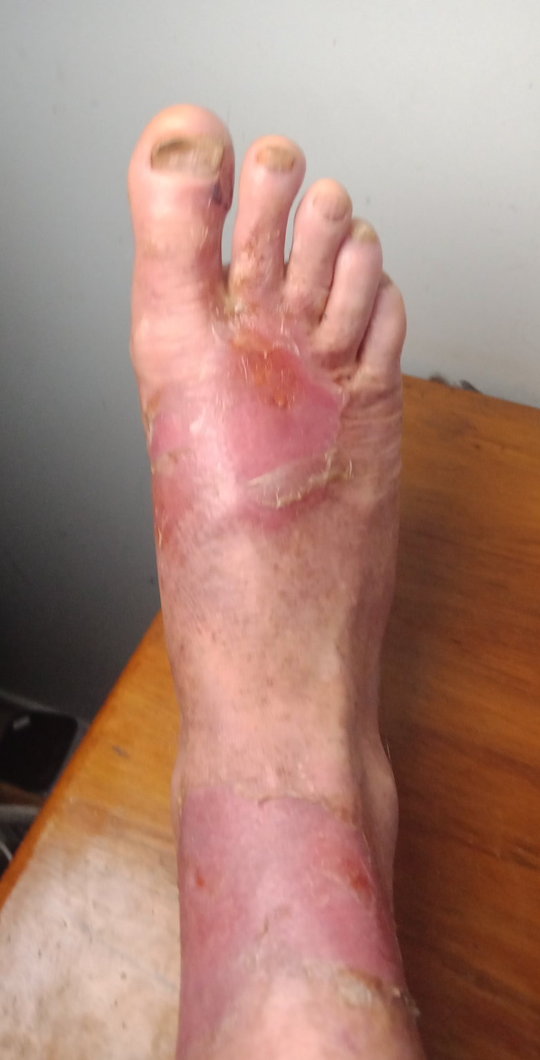 Foot with extensive red blistering, likely burn injury, resting on a wooden surface.