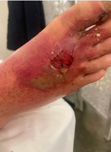 Foot with a deep, open wound and surrounding inflamed skin.