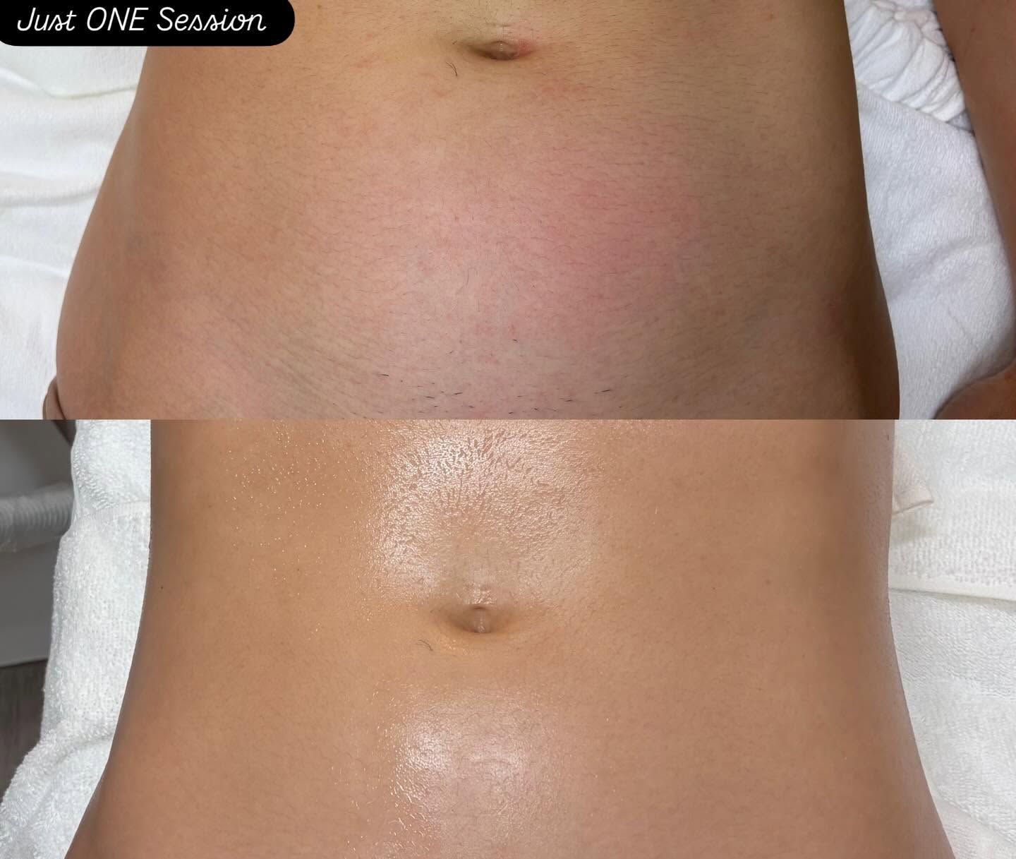Before-and-after abdomen photos showing reduced redness and smoother skin after treatment