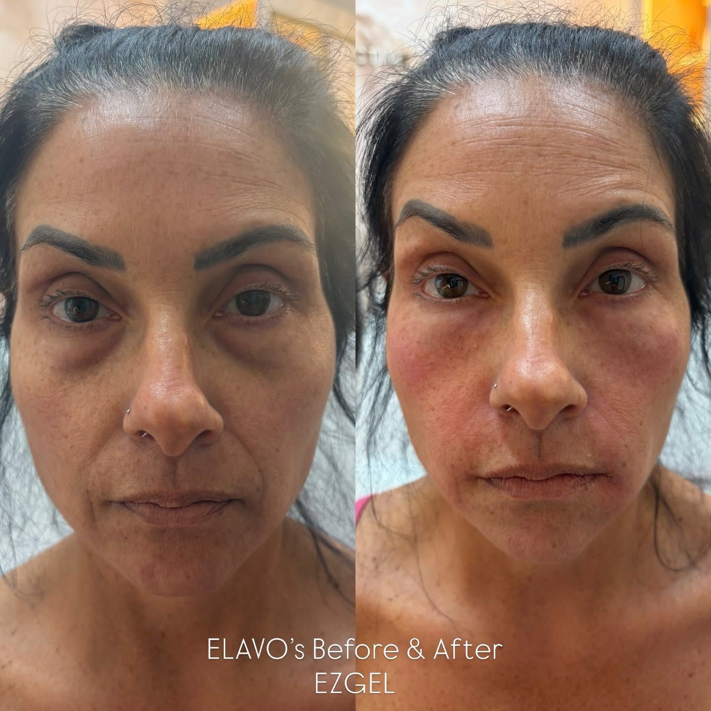 Side-by-side facial before-and-after image showing smoother skin and rosier cheeks.