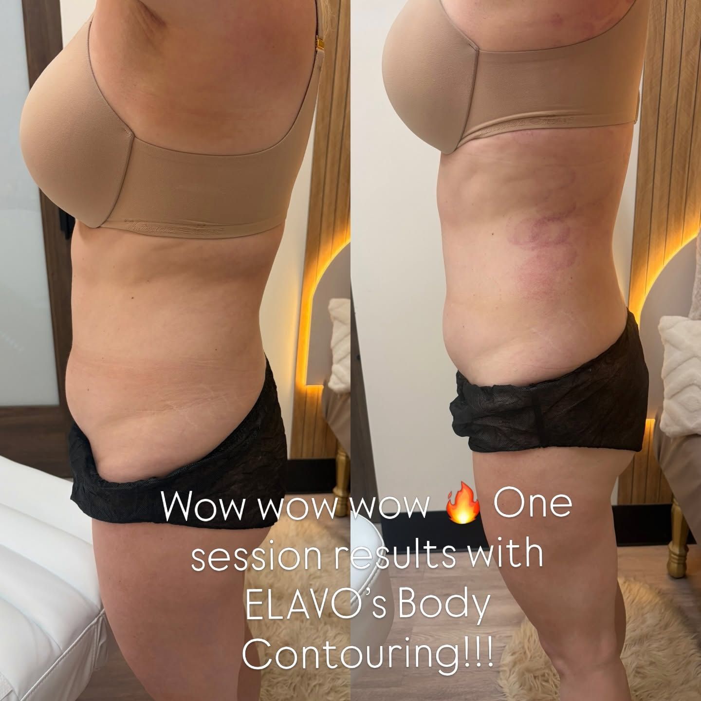 Side-by-side before-and-after torso and waist contouring photos in beige shapewear.