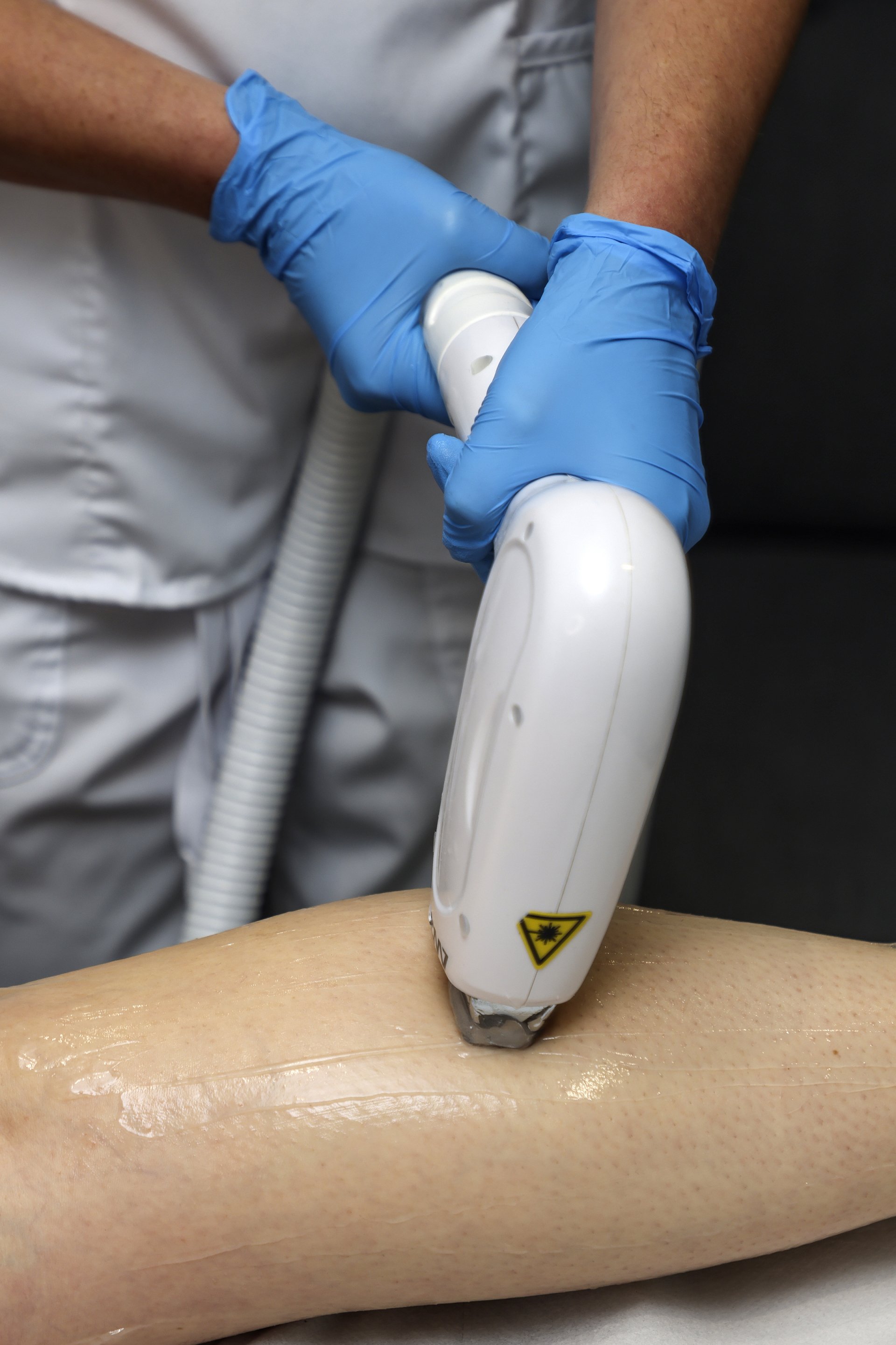 Laser Hereford I Affordable laser hair removal