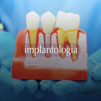 Implantologia e Chirurgia implantologia