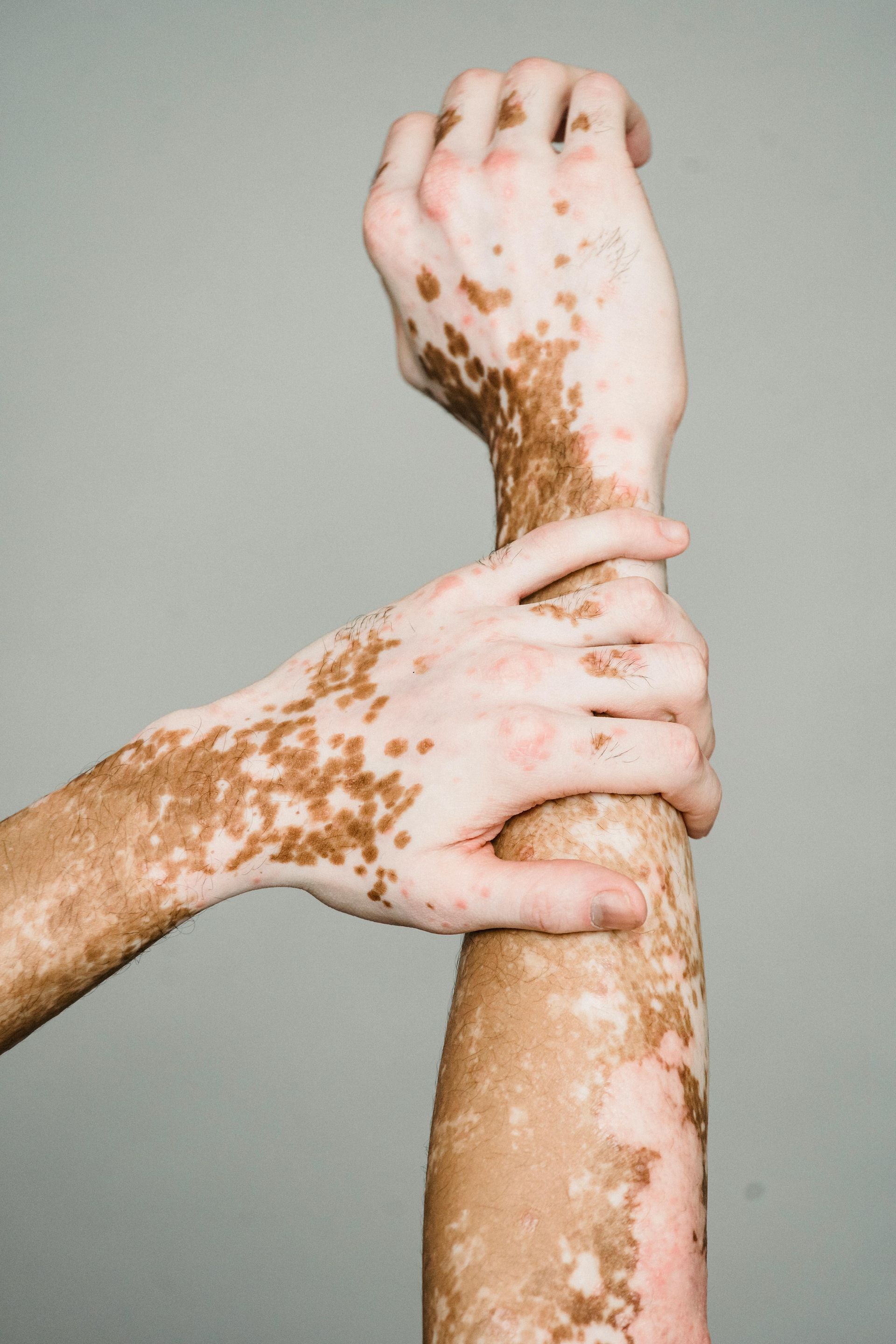 Two arms with vitiligo, one arm grasped by the other against a gray background.