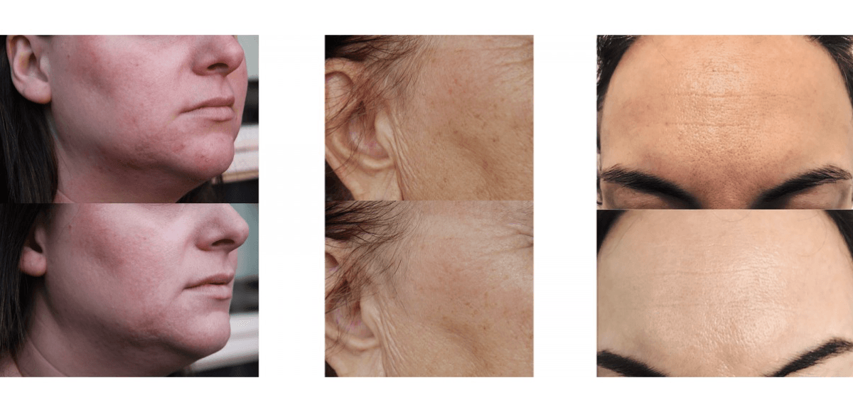 Bio peeling