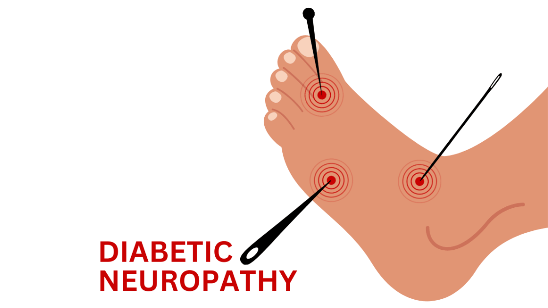Diagram of a foot with red pain spots and labeled diabetic neuropathy