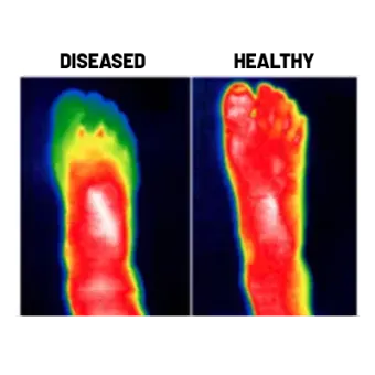 Thermal foot scans labeled diseased and healthy, showing hotter red-white diseased foot and cooler healthy foot