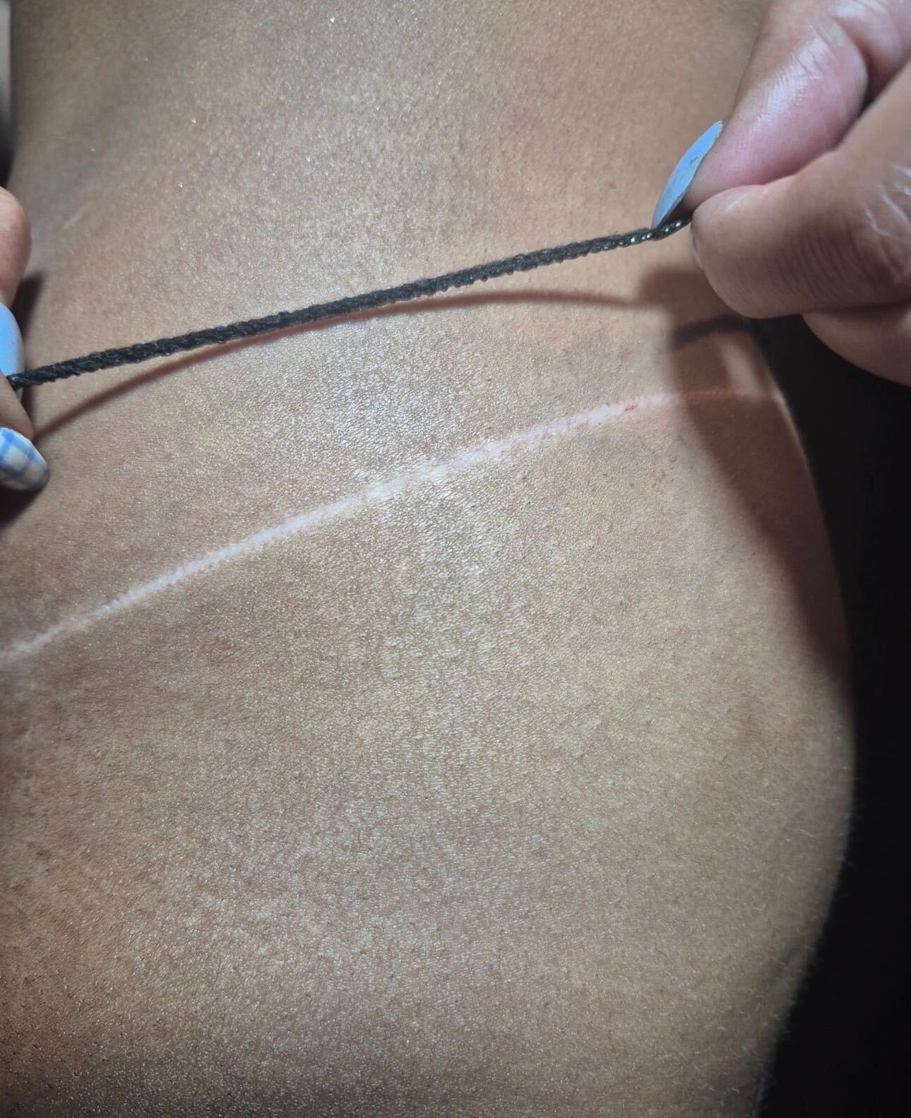 Hands pulling a black cord across a person’s bare back with a white diagonal scar