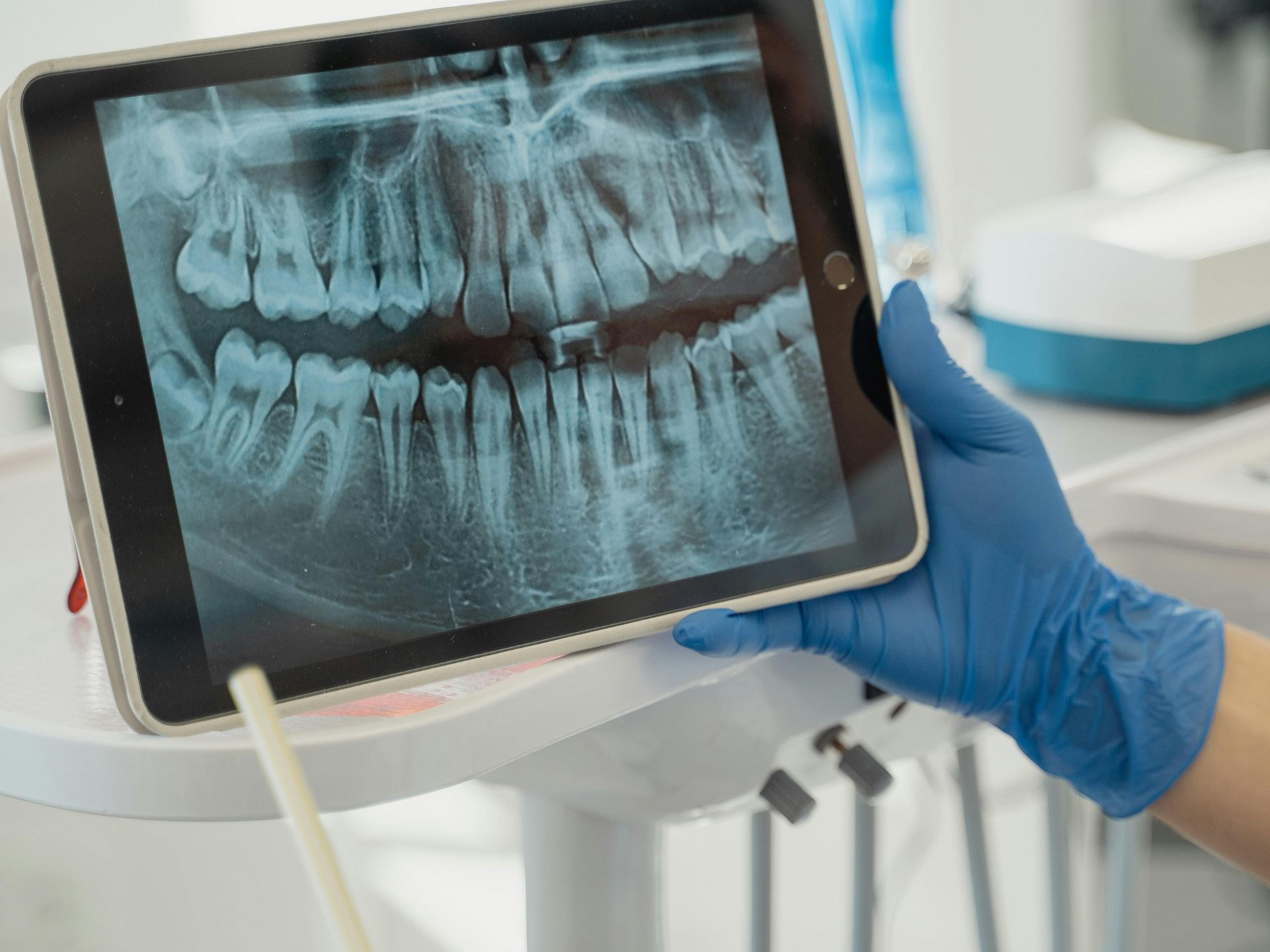 Digital dental X-ray display showing patient’s teeth and jaw