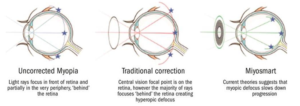 An image that shows how myopia can be corrected using special Hoya Miyosmart lenses.