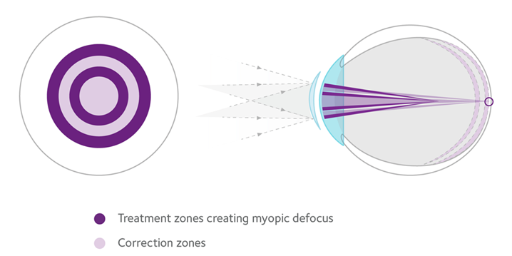 An illustration that shows how soft lenses work to improve myopia in children. 