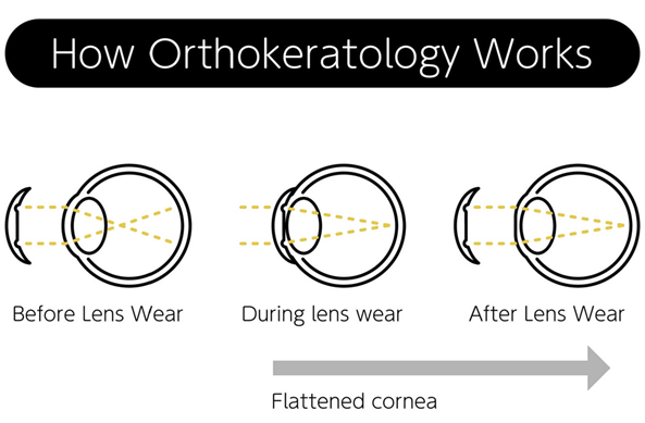 An illustration that shows how Orthokeratology works to reshape the cornea.