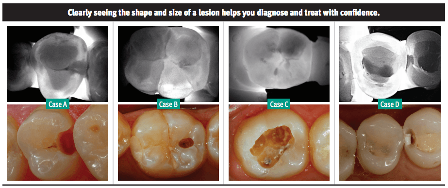 A poster showing different stages of tooth extraction