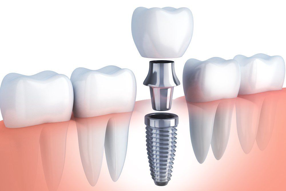 Dental Implant
