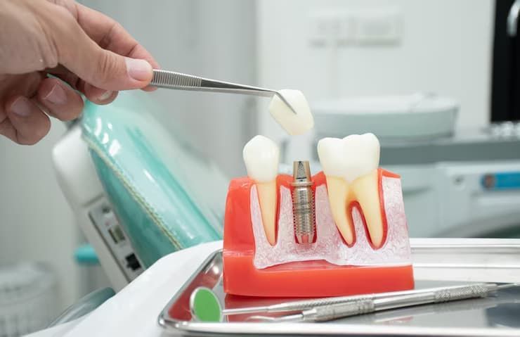 composite restorations in Mason

