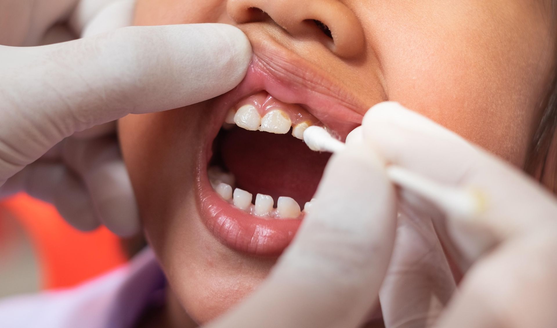 A gloved healthcare professional uses a cotton swab to apply a treatment to a patient's upper teeth.