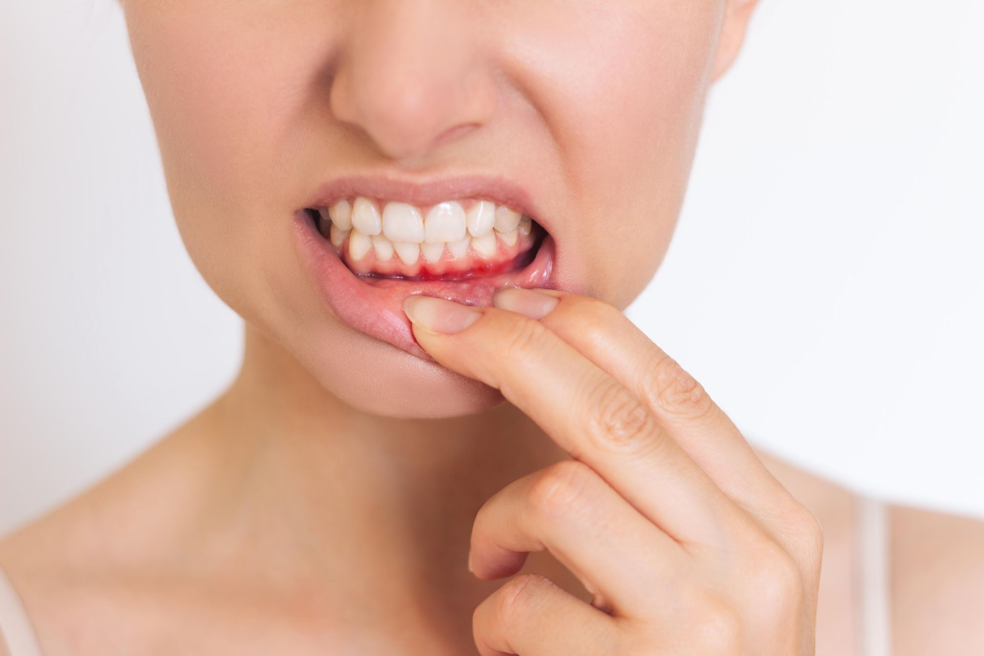 A person pulling down their lower lip to reveal inflamed, red gums.