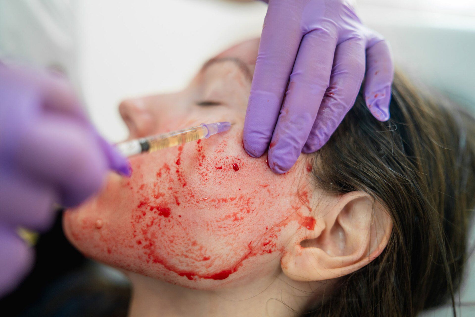 Vampire Facial — Sydney, NSW — Lulu Cosmetics