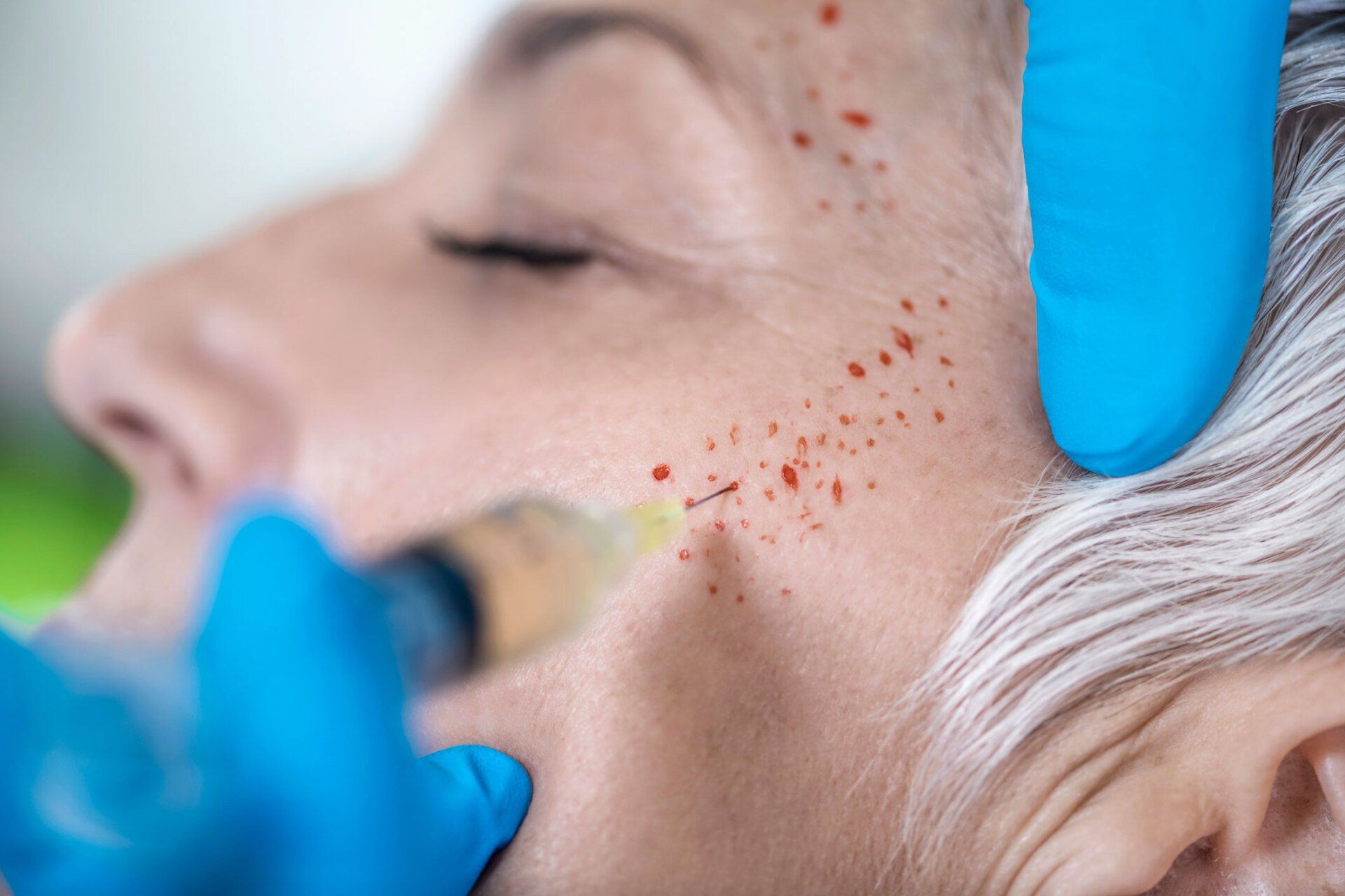 Platelet Rich Plasma Face Injection Treatment — Sydney, NSW — Lulu Cosmetics