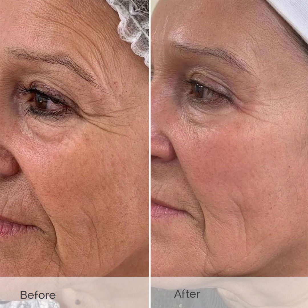 Before and After Treatments — Sydney, NSW — Lulu Cosmetics Before and After Treatments — Sydney, NSW — Lulu Cosmetics