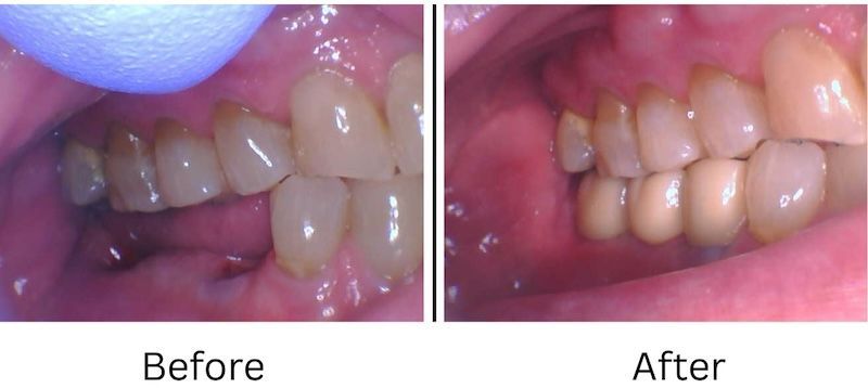 Dental Implants Before and After