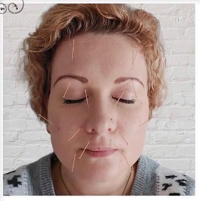 Anti-Age acupunctuur bij Elements of Beauty