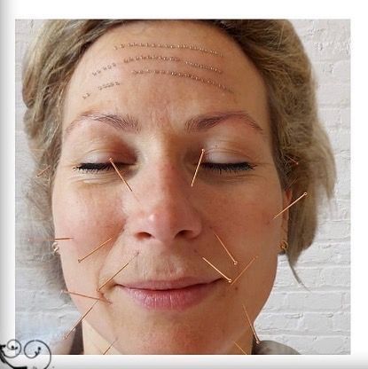 Anti-Age acupunctuur bij Elements of Beauty