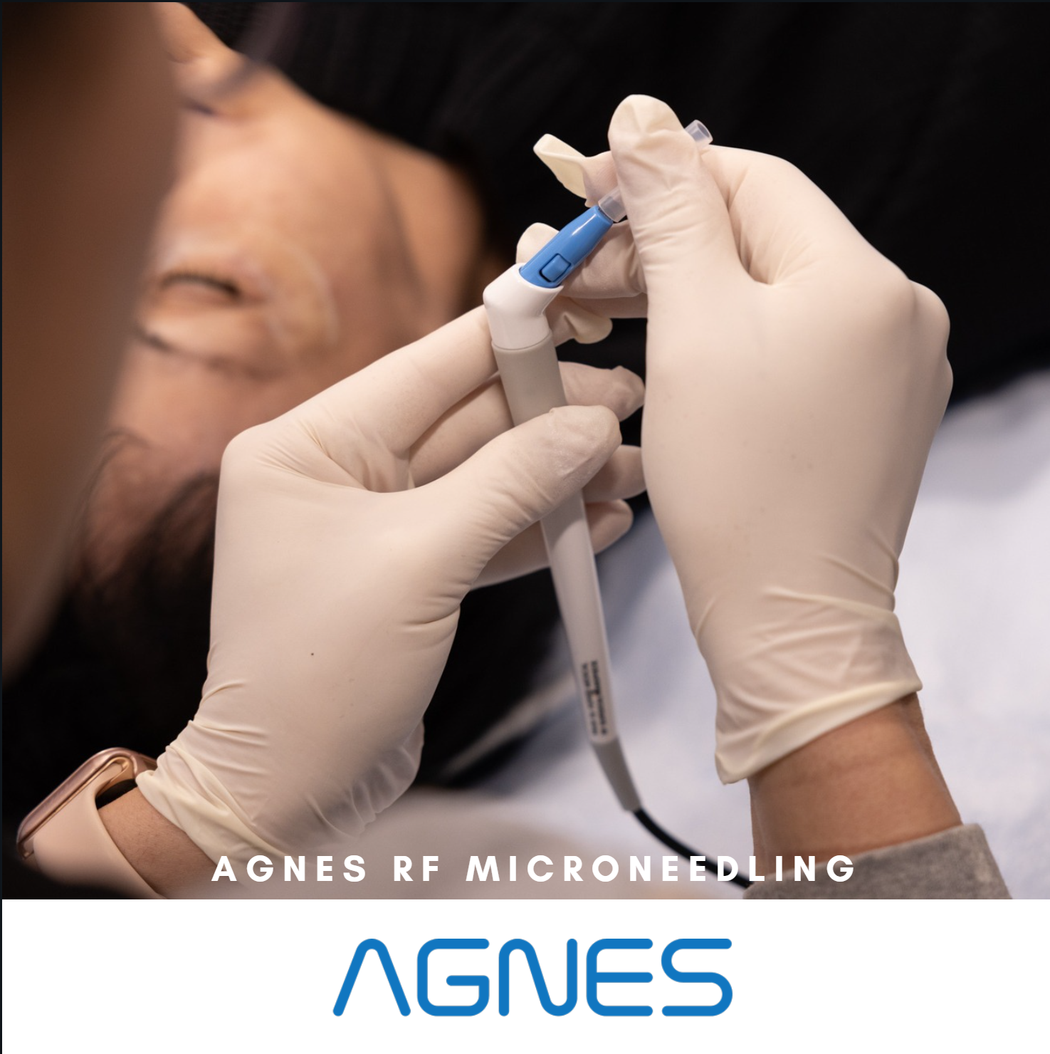 Gloved hands preparing an AGNES microneedling device near a client’s face