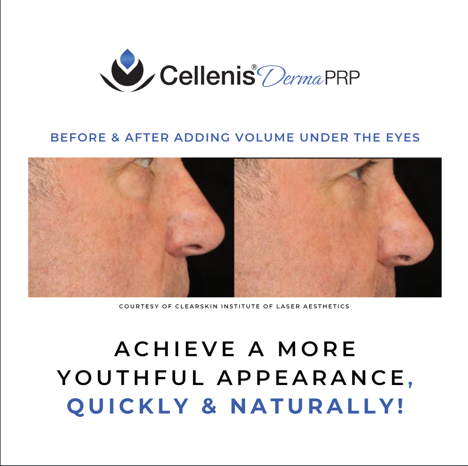 Before-and-after side profile showing under-eye volume improvement, with Cellenis Derma PRP branding and slogan.