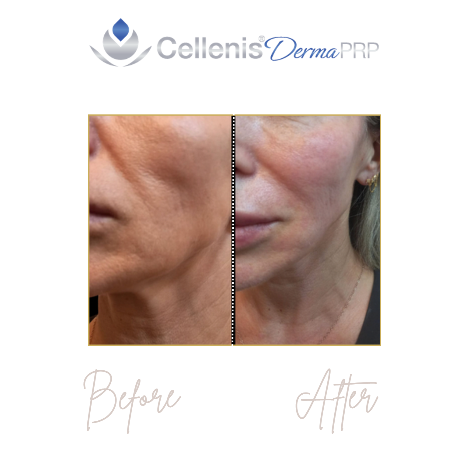 Before-and-after close-up of a neck and jawline showing smoother skin and reduced wrinkles.