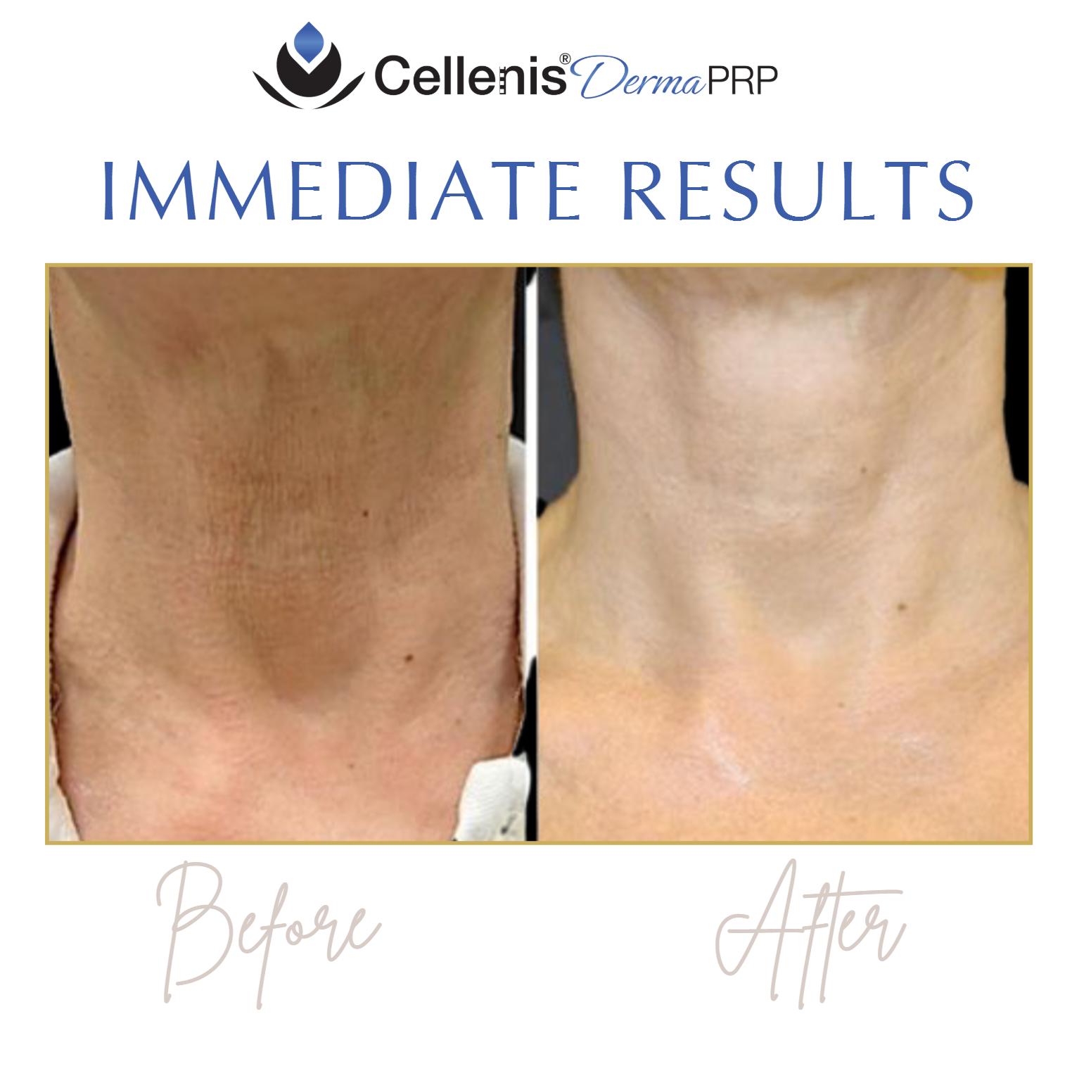 Before-and-after neck skin treatment results with clearer skin and reduced lines.