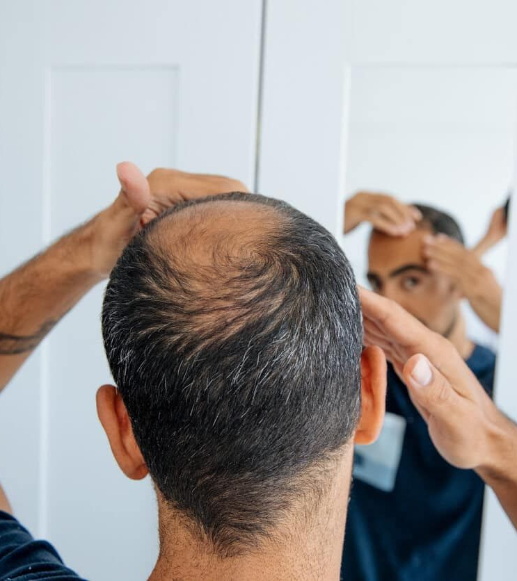 Man checking his balding scalp in a bathroom mirror while touching his hairline