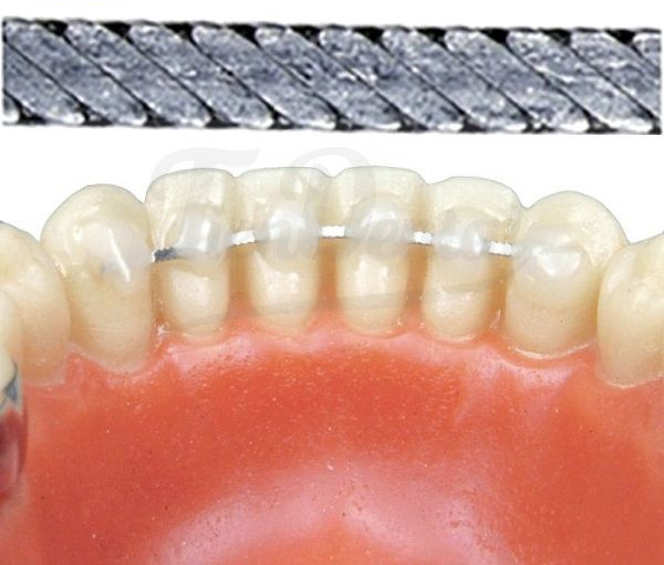 Primer plano de los dientes frontales inferiores con un alineador dental transparente y un alambre trenzado gris