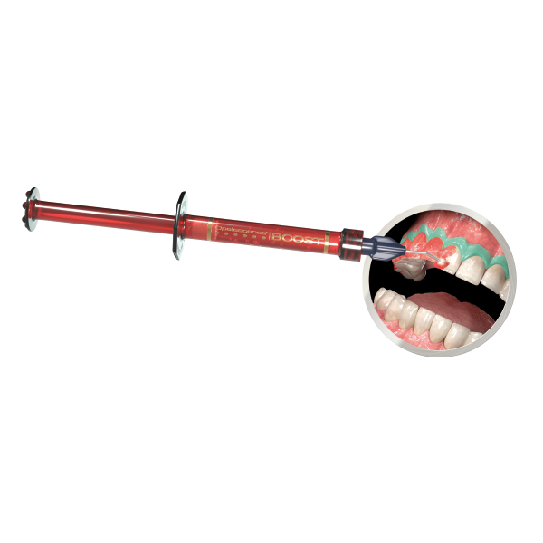 Dispositivo dental rojo con vista ampliada de los dientes y las encías dentro de la boca.