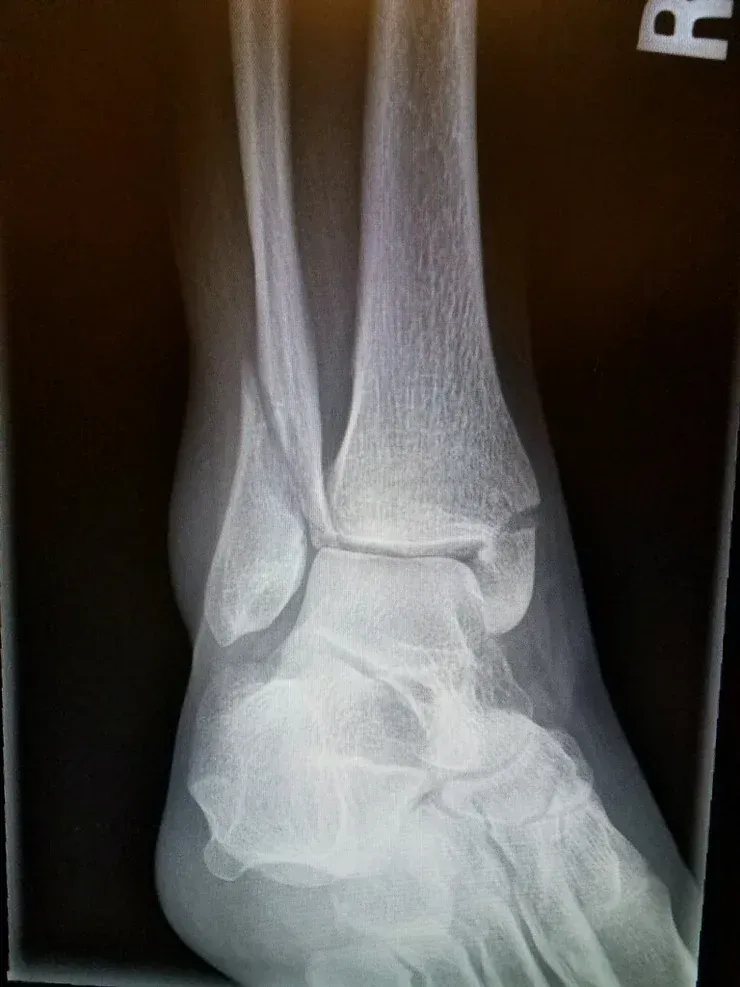 An x-ray of a person 's ankle with a broken bone.