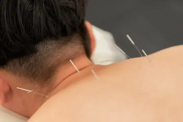 Medical Acupuncture in Malvern