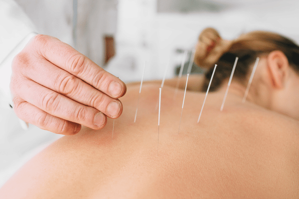 Medical Acupuncture