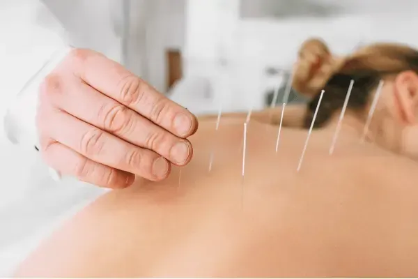 Medical Acupuncture