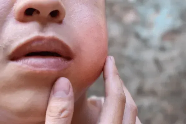 Mumps and Rubella