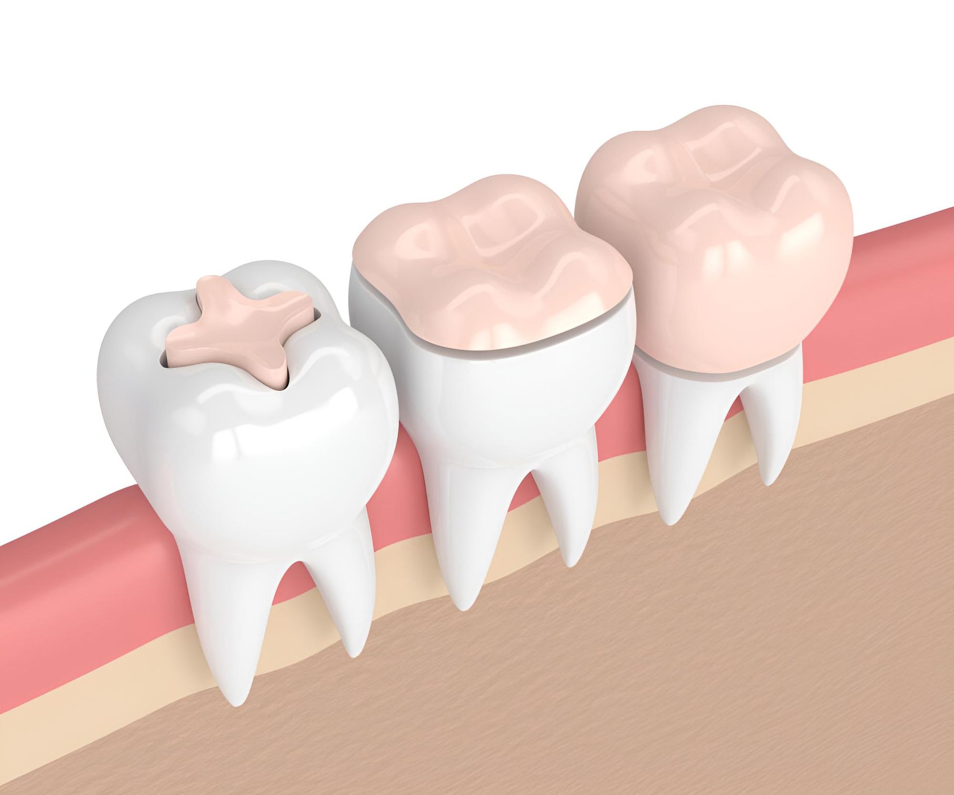 A 3D Rendering of Three Teeth With Fillings in Them — Trower Dental In Palmerston, NT