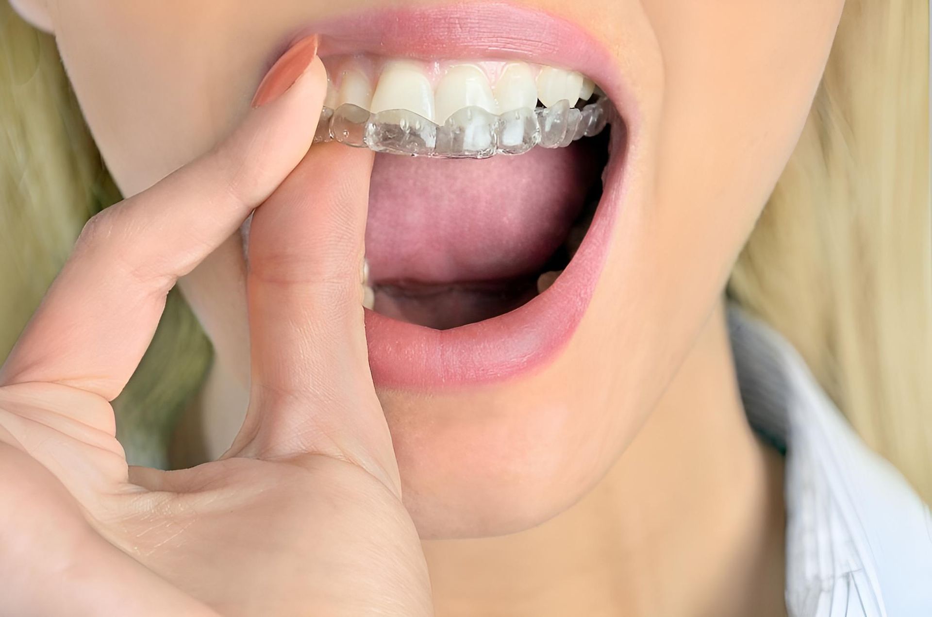 A Close Up of a Woman's Mouth With Braces on Her Teeth — Trower Dental In Casuarina, NT