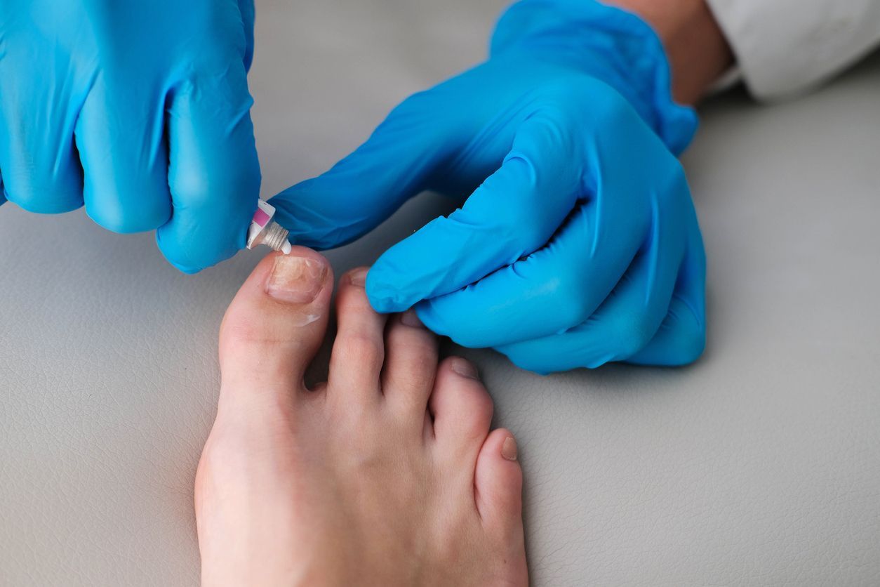 Onicomicosis y Limpieza