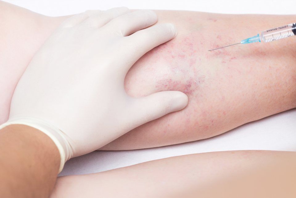 trattamento dei capillari gambe