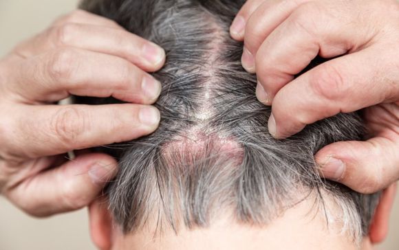 alopecia