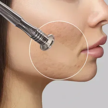 Microdermabrasion