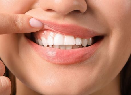 Close-up of a smiling mouth with a finger pulling back the upper lip to show white teeth