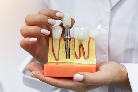 Dental implant model held by hands, showing teeth, gums, and implant post in close-up.