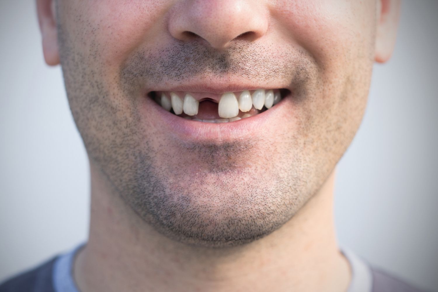 Close-up of a smiling mouth with a missing front tooth.