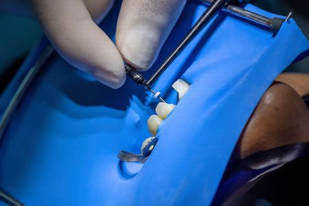 Dentist using metal tools on a patient’s tooth with a blue dental drape