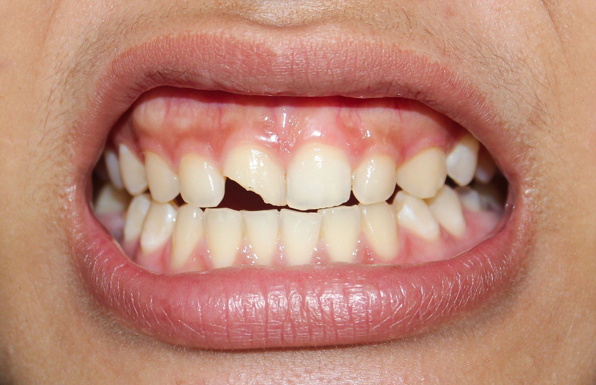 Close-up of lips showing crooked front teeth with a gap between the upper incisors.